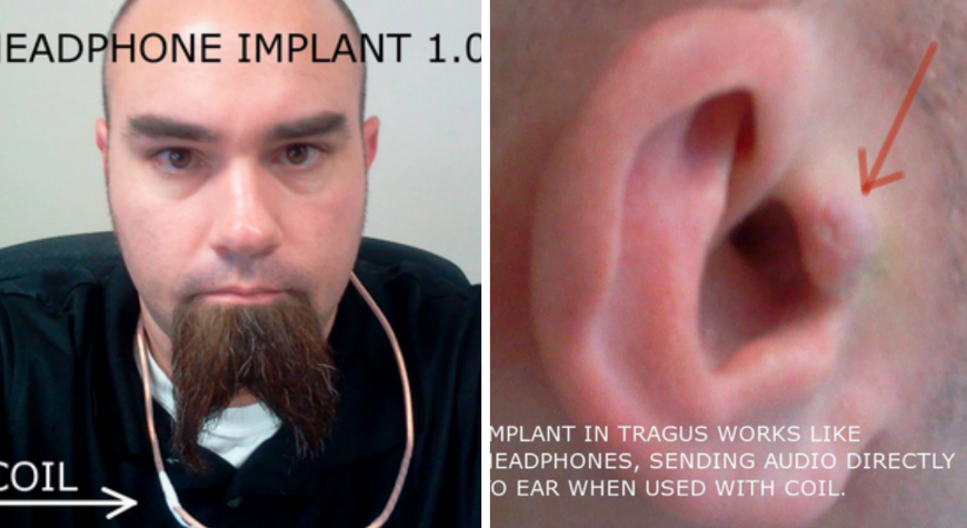öra, Hörlurar, Implantat